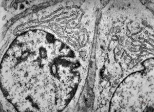 M,1y. | neuroblastoma - submandibular region